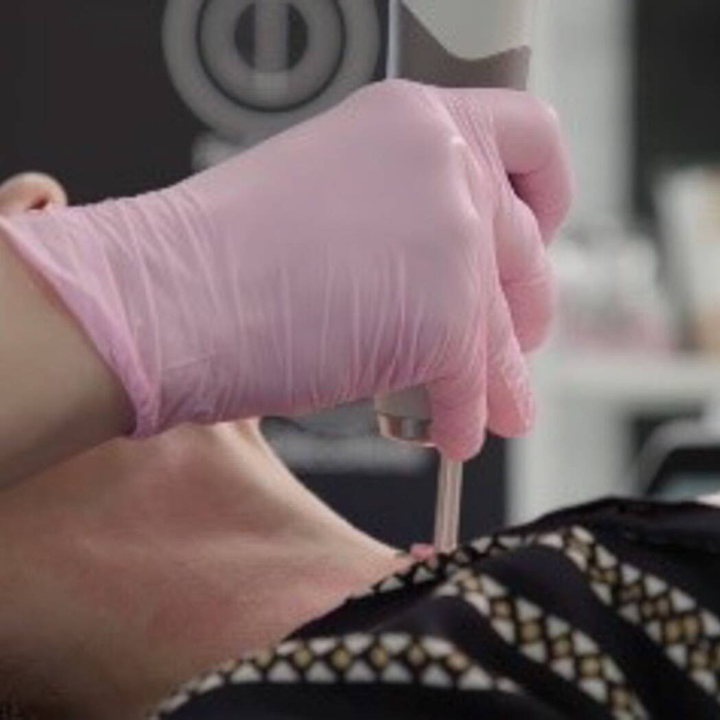 Neck Decolletage Laser treatment on neck area at Beauty Refined, Greenwood Village.