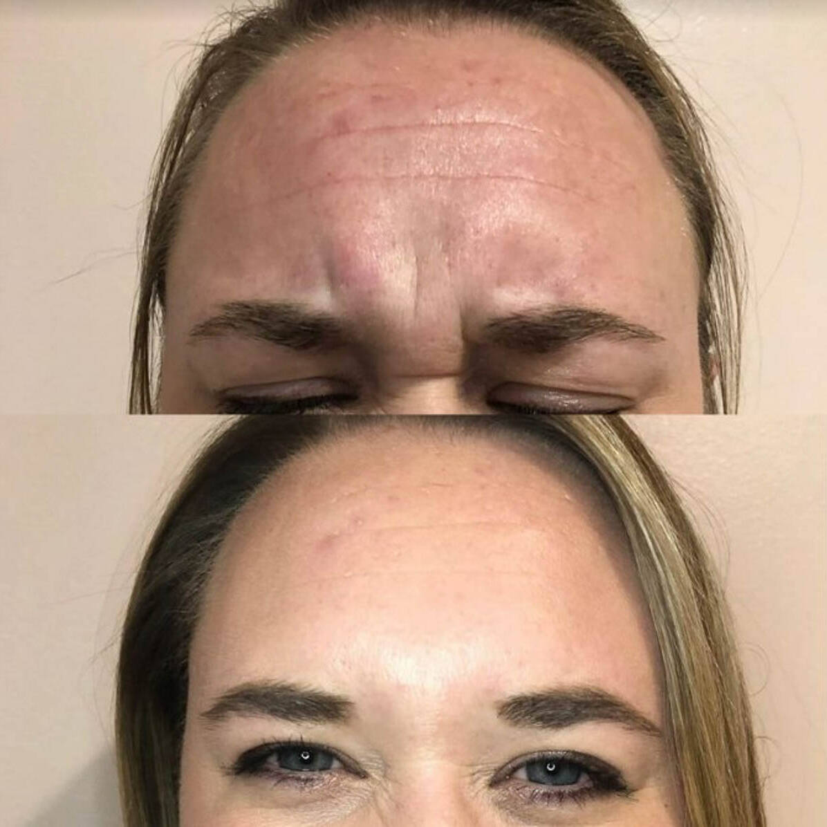 Neurotoxin 2 - Frown Lines & Forehead | Neurotoxin 3 Forehead Lines | Beauty Refined in Denver Tech Center, & Parker Colorado