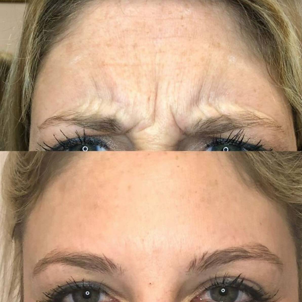 Neurotoxin 4 Frown Lines | Beauty Refined in Denver Tech Center, & Parker Colorado