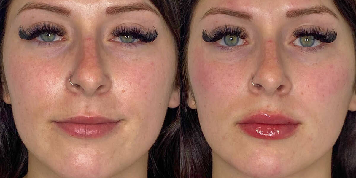 Cheek Under Eye Filler | Before and After Gallery