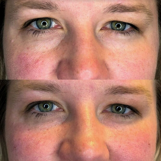 Cheek Under Eye Filler | Before and After Gallery