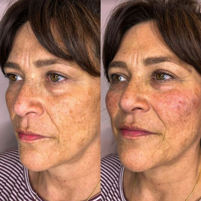 Cheek Under Eye Filler | Before and After Gallery | Beauty Refined