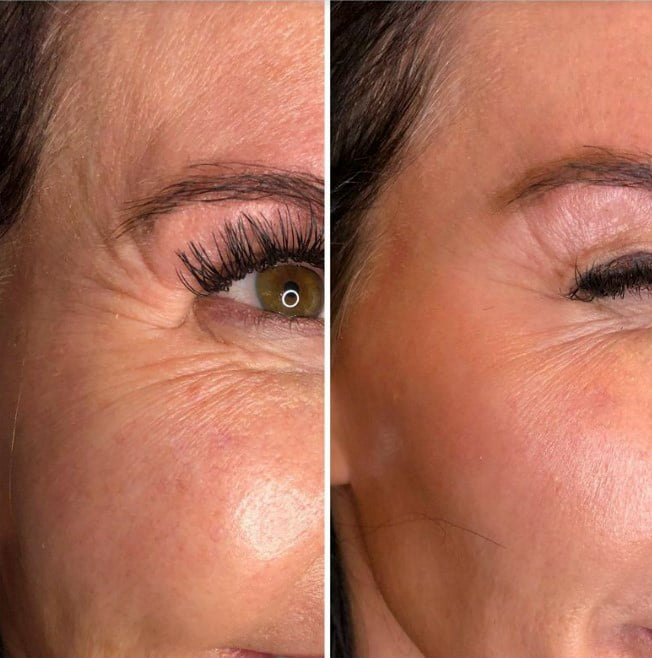 Extract and Glow Facial Treatments in Parker CO by Beauty Refined