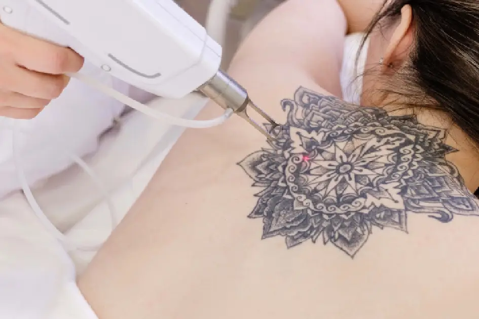 A woman receiving laser treatment on a large black tattoo on her upper back, illustrating Laser Tattoo Removal in Greenwood Village, CO.