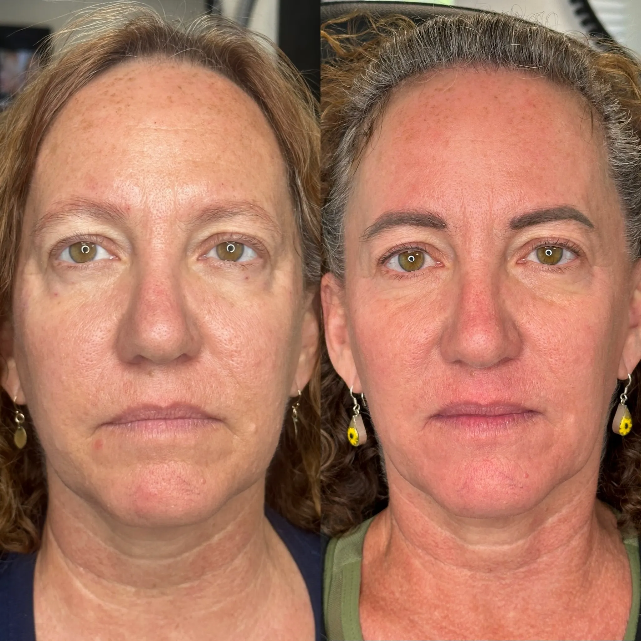 Female Sculptra patient before and after collagen-boosting injectable treatment for neck and jawline